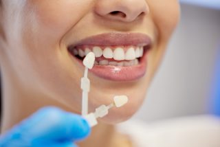 installation de facettes dentaires à une patiente